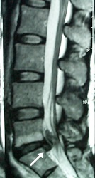 safe removal of the disc fragments
